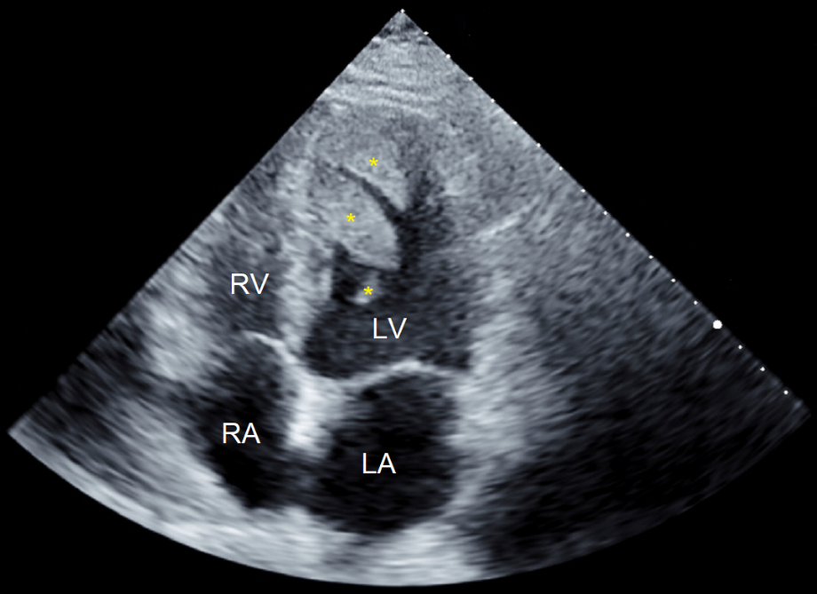 Multiple Sizeable Left Ventricular Thrombi in a Patient with Anti-Phospholipid Syndrome