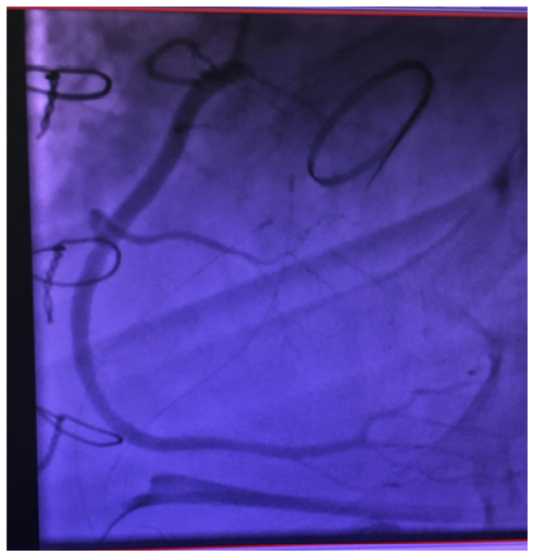 Right coronary artery injury after tricuspid ring annuloplasty