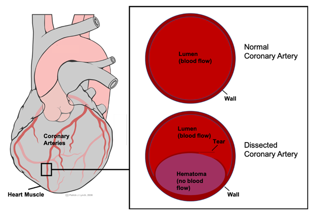 Spontaneous Coronary Artery Dissection: An Overview of Pathophysiology, Diagnosis, and Management